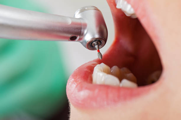 Best Emergency Tooth Extraction in Sycamore, GA